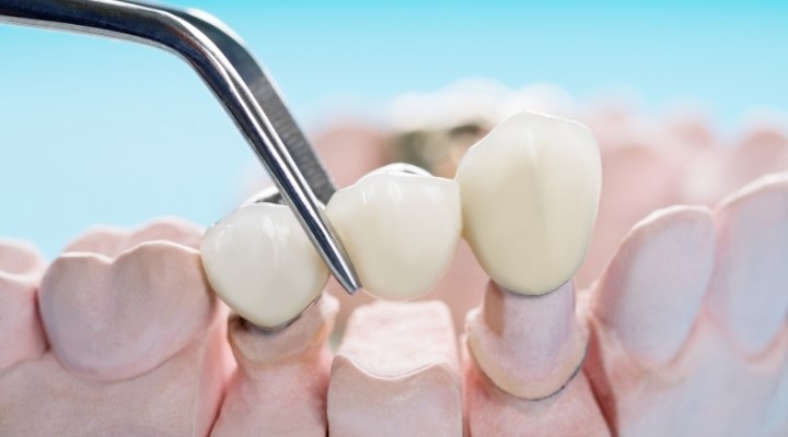 Dental Crown and Bridge Treatment in Kalyan