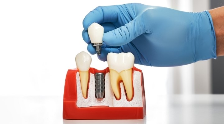 Dental Implant Treatment in Kalyan