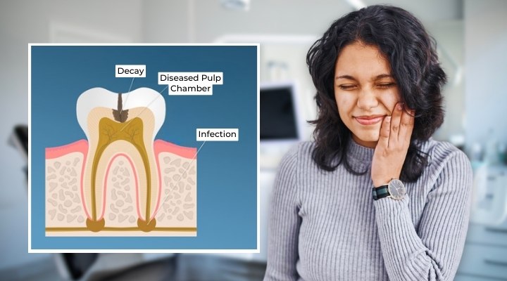 Root Canal Treatment In Kalyan