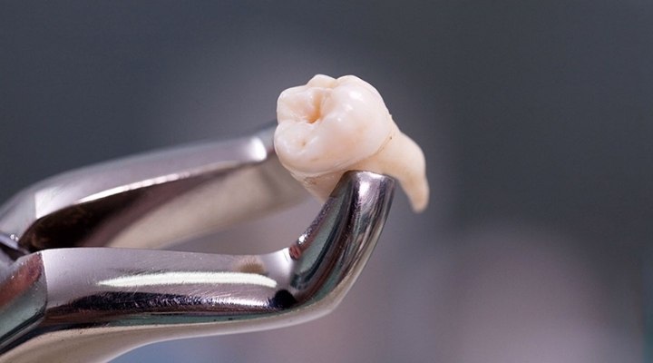 Wisdom Tooth Removal In Kalyan